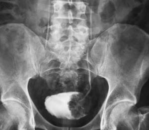 X-ray of Bladder Cancer